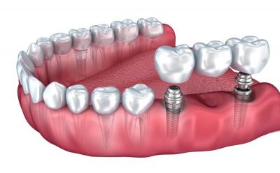 Мостовидный протез на имплантах (протезирование без обточки соседних зубов).