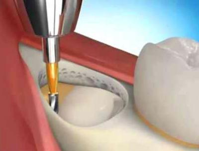 Как удаляют ретинированные зубы