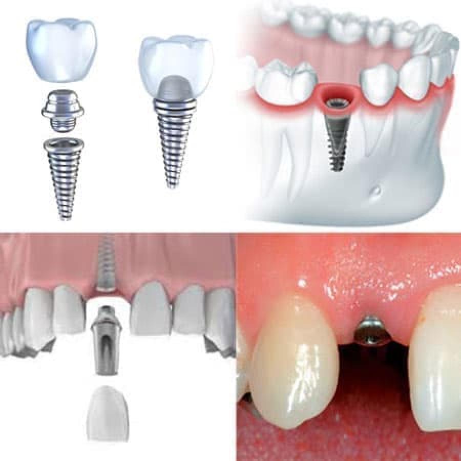 Пошагово как ставить импланты. Одномоментная имплантация зубов этапы. Формирователь десны Nobel Biocare. Зубные имплантаты стелс. Этапы имплантации зубов абатмент.